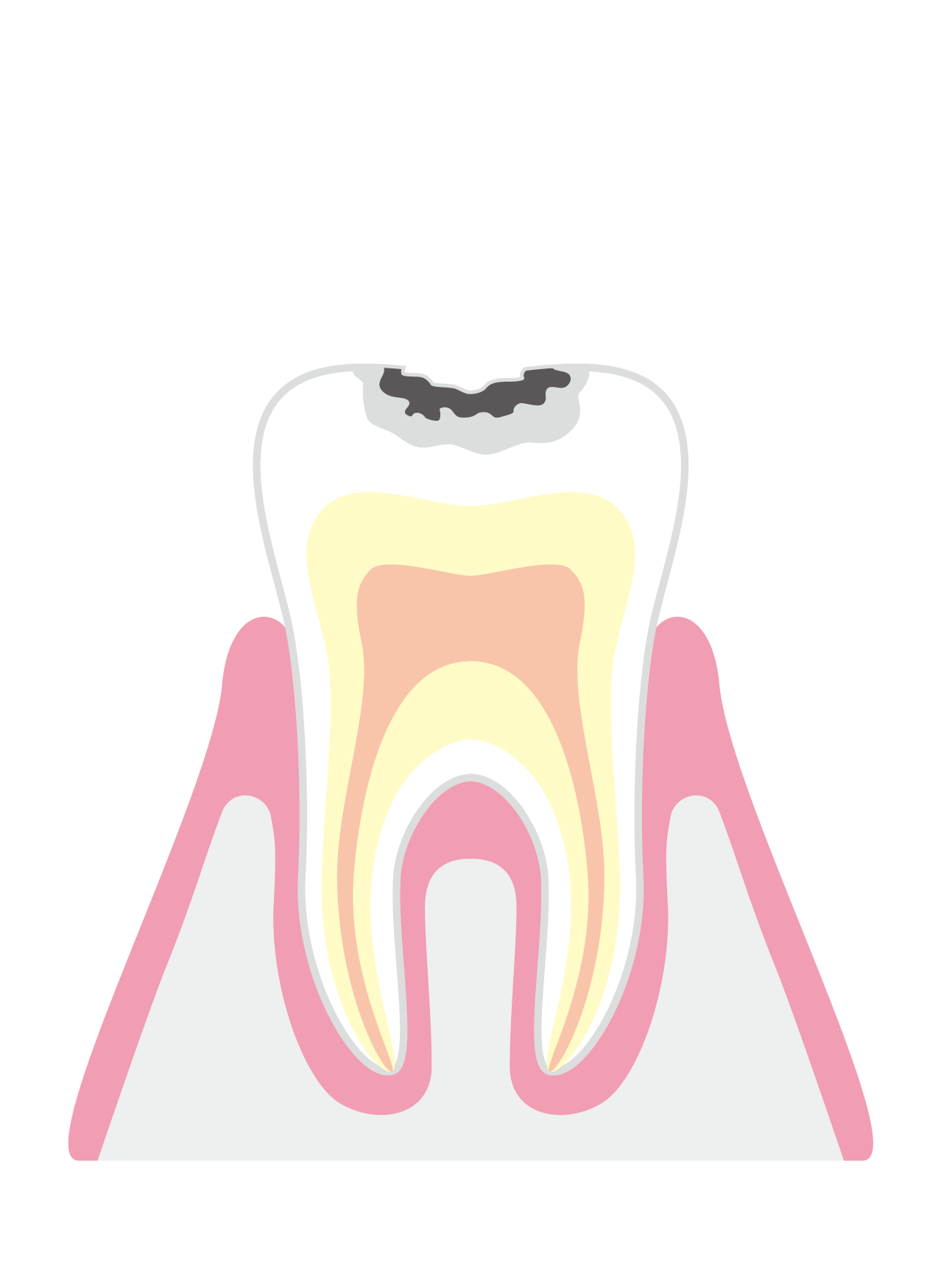 初期むし歯（C1）