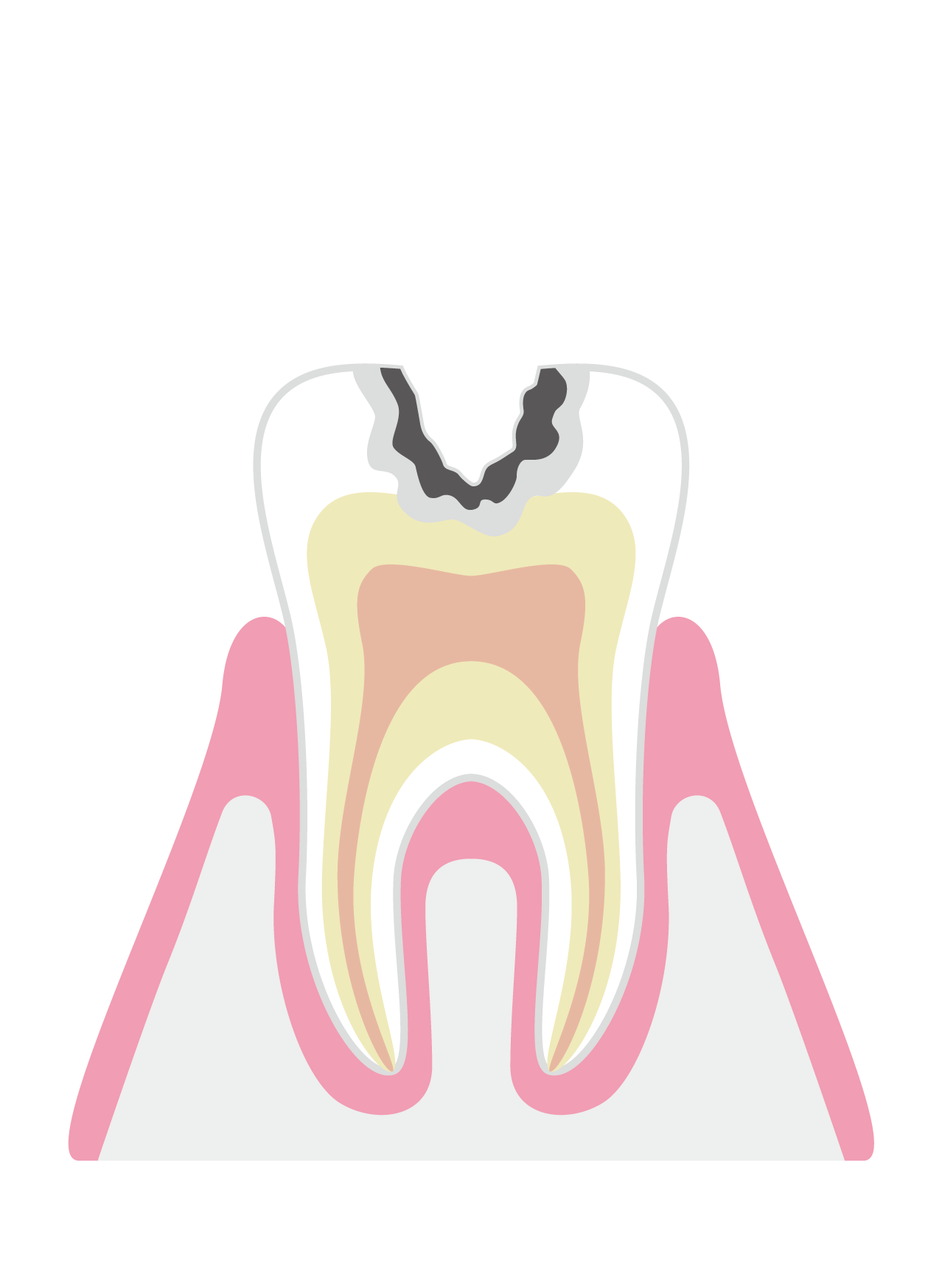 象牙質まで進行したむし歯（C2）