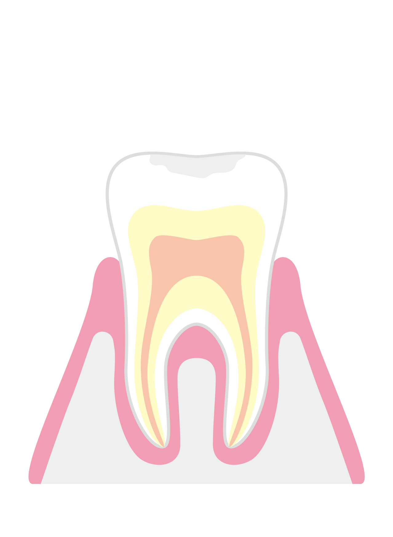 初期むし歯（CO）