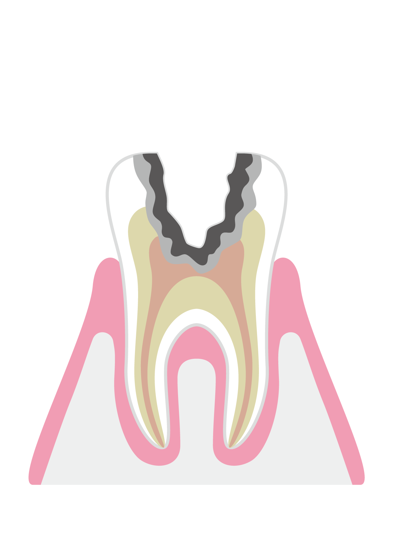 神経まで進行したむし歯（C3）